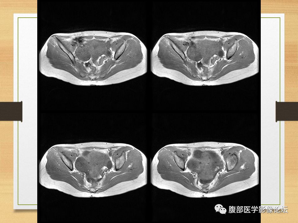 【病例】右侧卵巢卵泡膜纤维瘤1例MR
