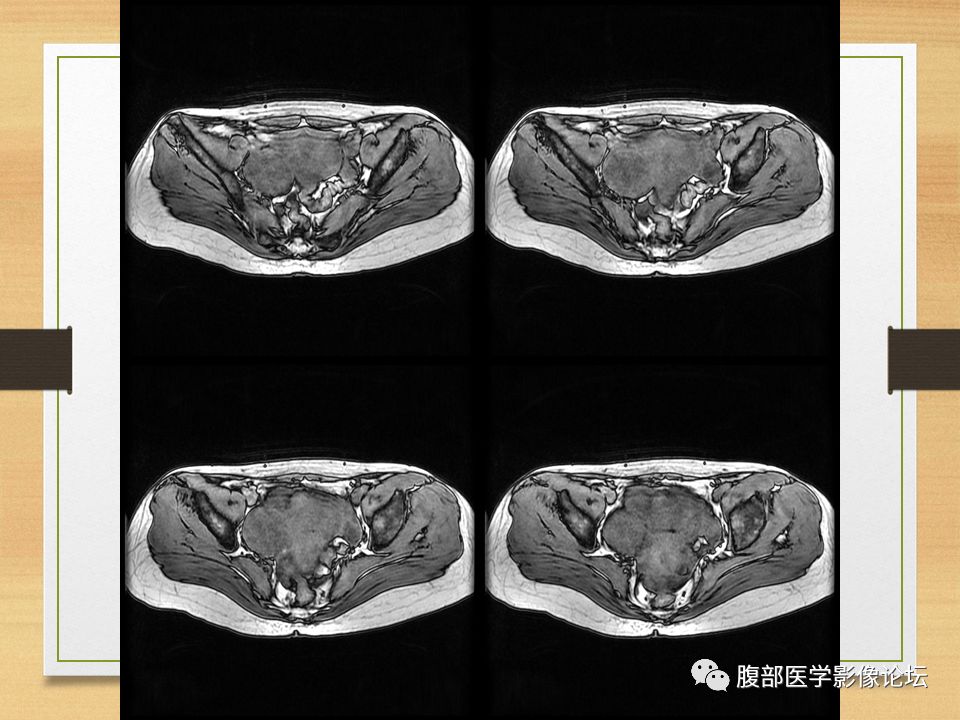 【病例】右侧卵巢卵泡膜纤维瘤1例MR