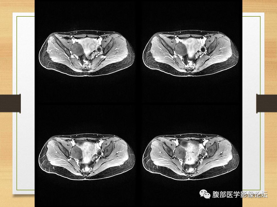 【病例】右侧卵巢卵泡膜纤维瘤1例MR