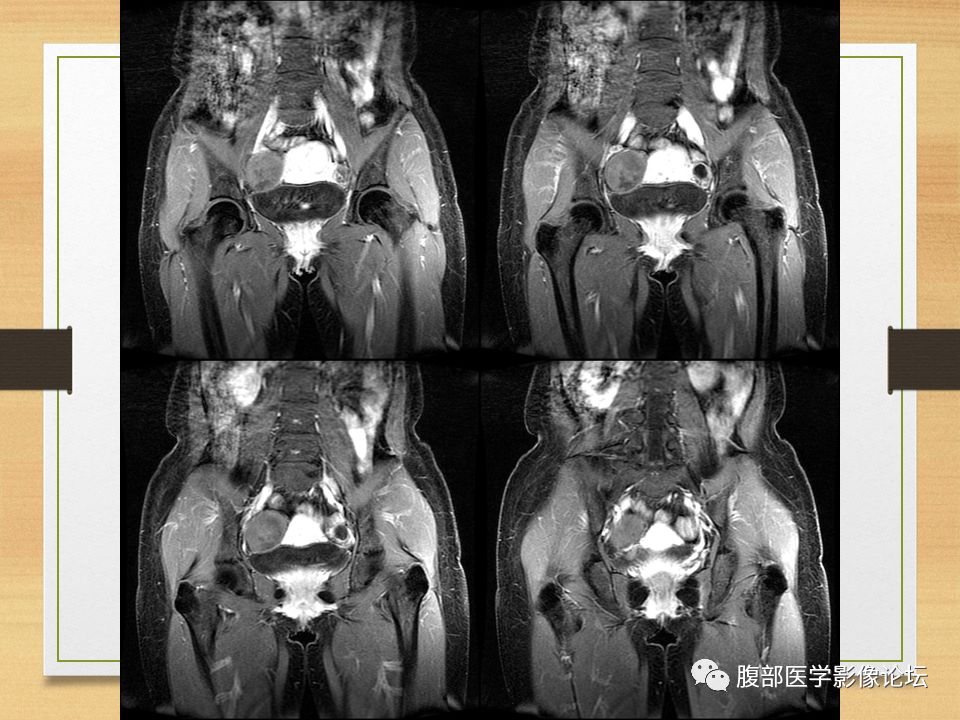 【病例】右侧卵巢卵泡膜纤维瘤1例MR