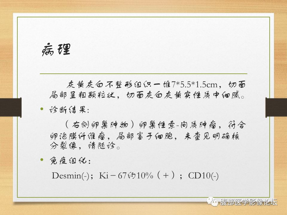 【病例】右侧卵巢卵泡膜纤维瘤1例MR