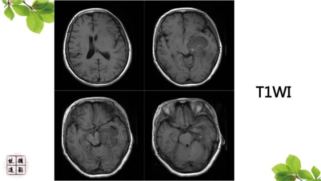 【病例】颅内血管内皮瘤1例MR影像诊断 【病例】颅内血管内皮瘤1例MR影像诊断