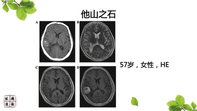 【病例】颅内血管内皮瘤1例MR影像诊断 【病例】颅内血管内皮瘤1例MR影像诊断