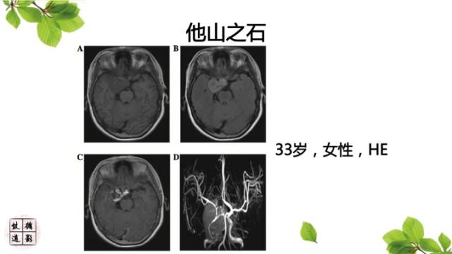 【病例】颅内血管内皮瘤1例MR影像诊断 【病例】颅内血管内皮瘤1例MR影像诊断