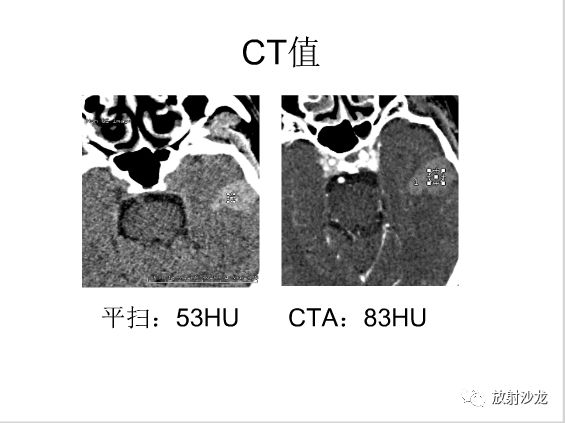 【病例】左颞部异位垂体瘤1例CT及MR