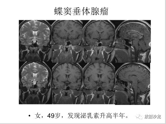 【病例】左颞部异位垂体瘤1例CT及MR