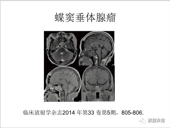 【病例】左颞部异位垂体瘤1例CT及MR
