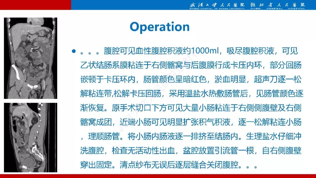 【PPT】腹内疝影像诊断