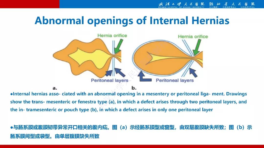 【PPT】腹内疝影像诊断