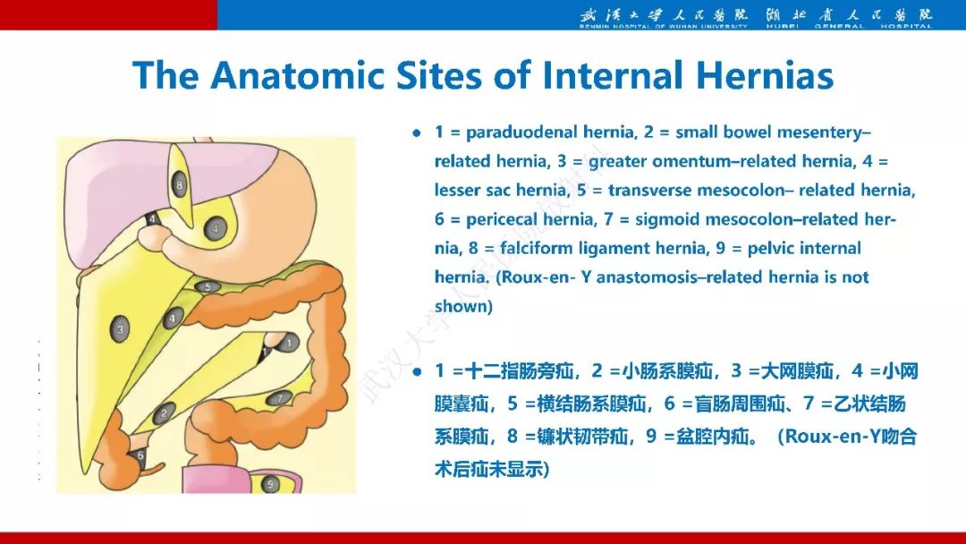 【PPT】腹内疝影像诊断