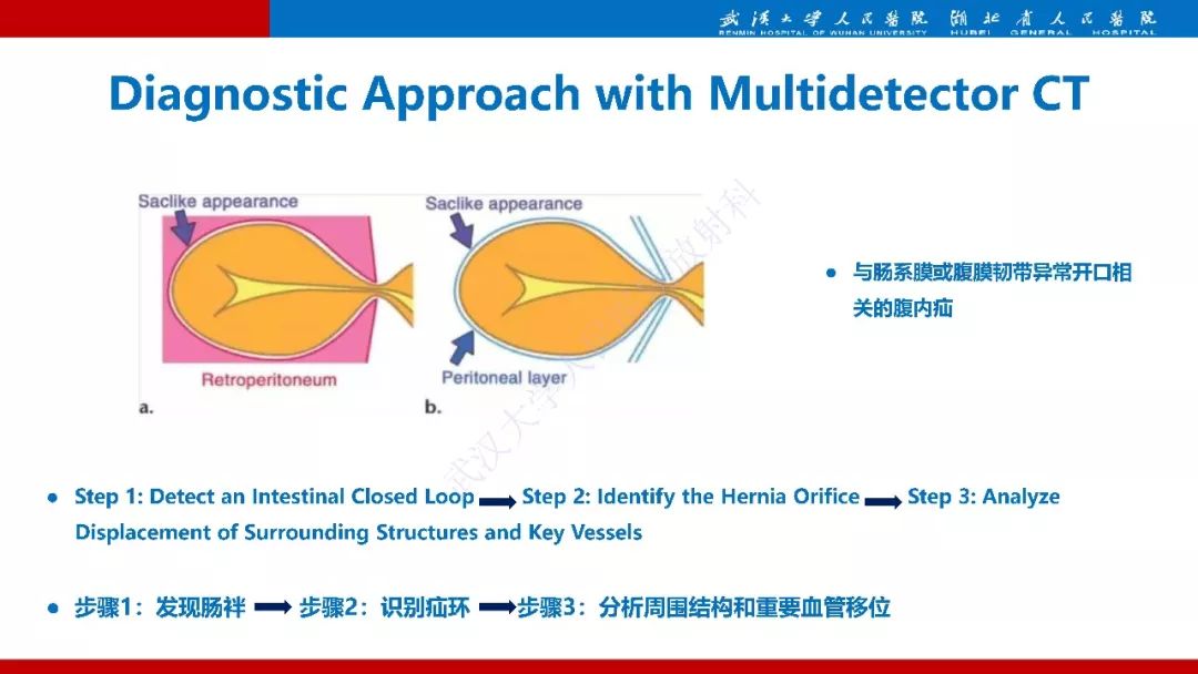 【PPT】腹内疝影像诊断