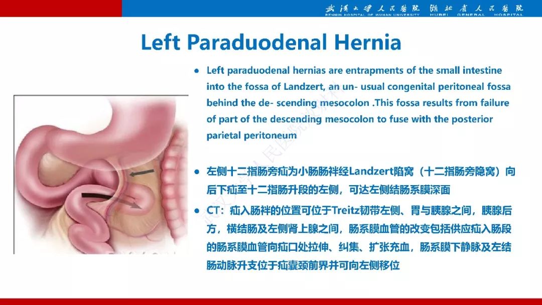 【PPT】腹内疝影像诊断