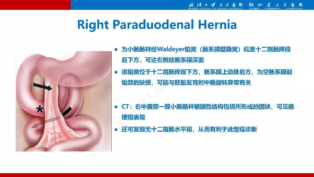 【PPT】腹内疝影像诊断