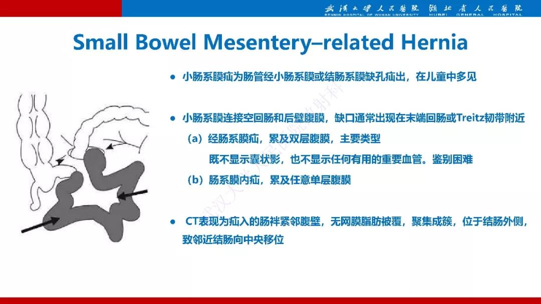【PPT】腹内疝影像诊断