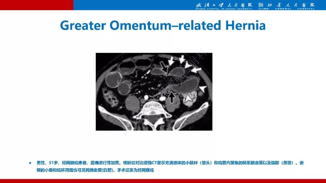 【PPT】腹内疝影像诊断