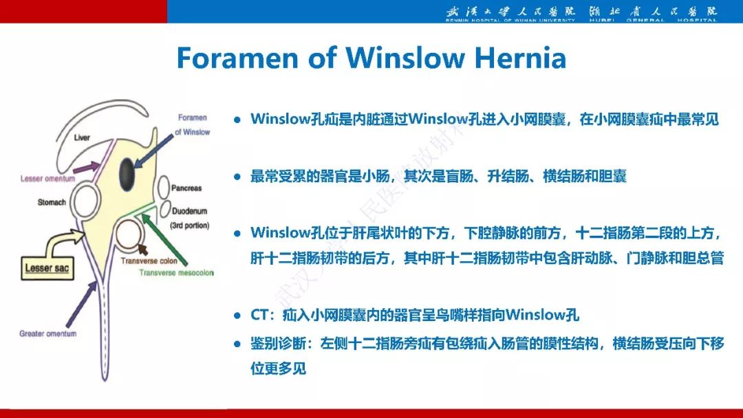 【PPT】腹内疝影像诊断
