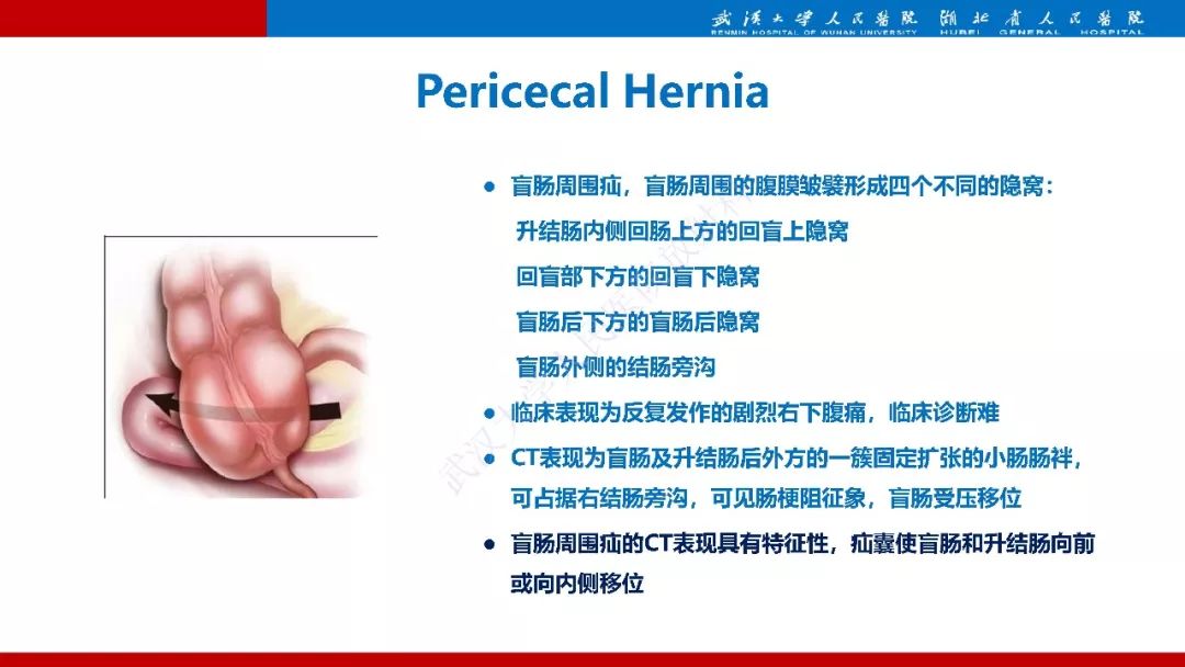 【PPT】腹内疝影像诊断