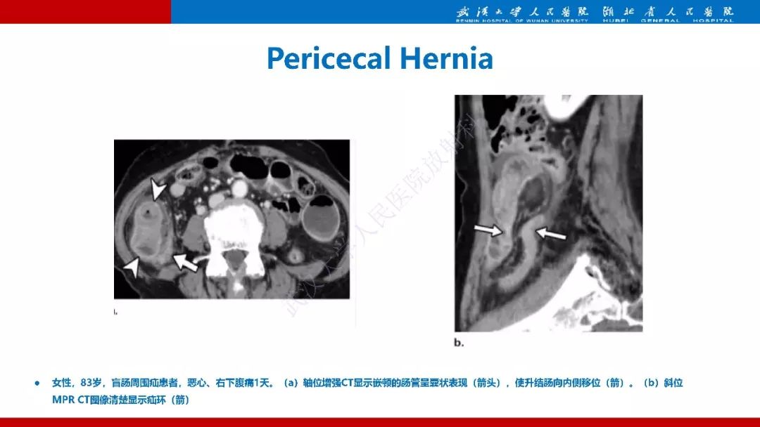 【PPT】腹内疝影像诊断