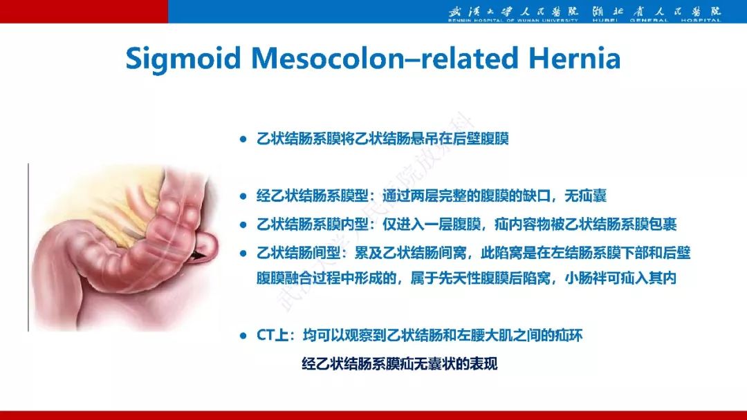 【PPT】腹内疝影像诊断