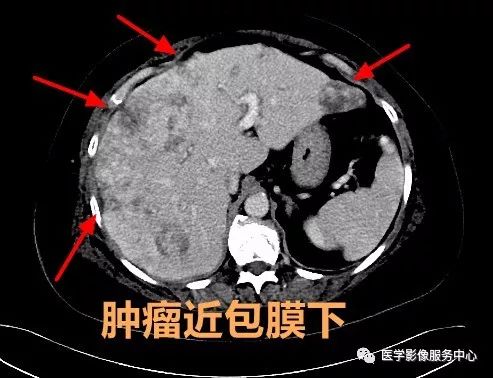 掌握3个要点，秒杀肝脏上皮样血管内皮瘤