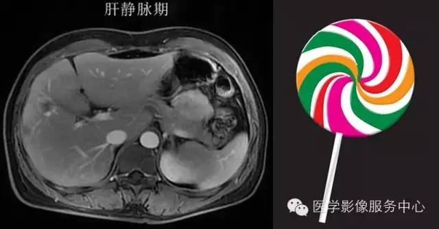 掌握3个要点，秒杀肝脏上皮样血管内皮瘤