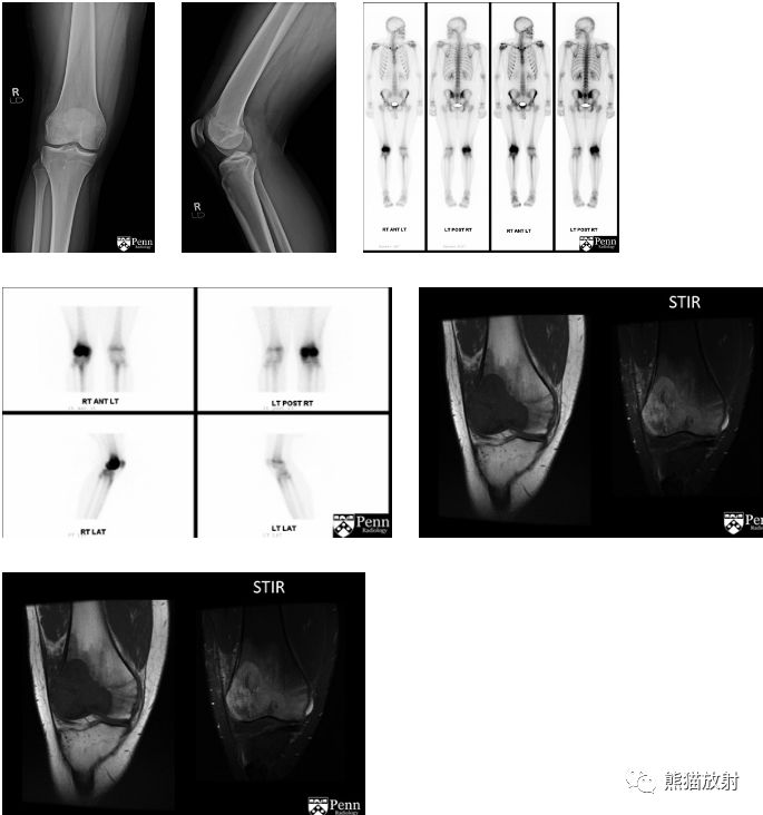 【病例】原发性骨淋巴瘤1例X线ECT及MR影像表现 【病例】原发性骨淋巴瘤1例X线ECT及MR影像表现