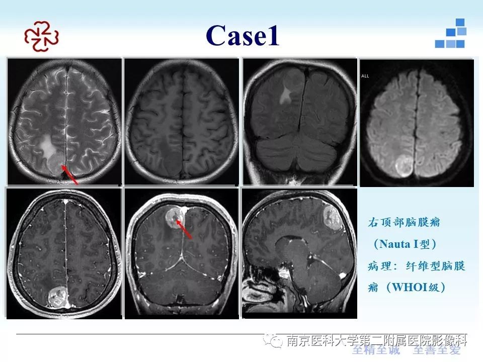【PPT】囊性脑膜瘤