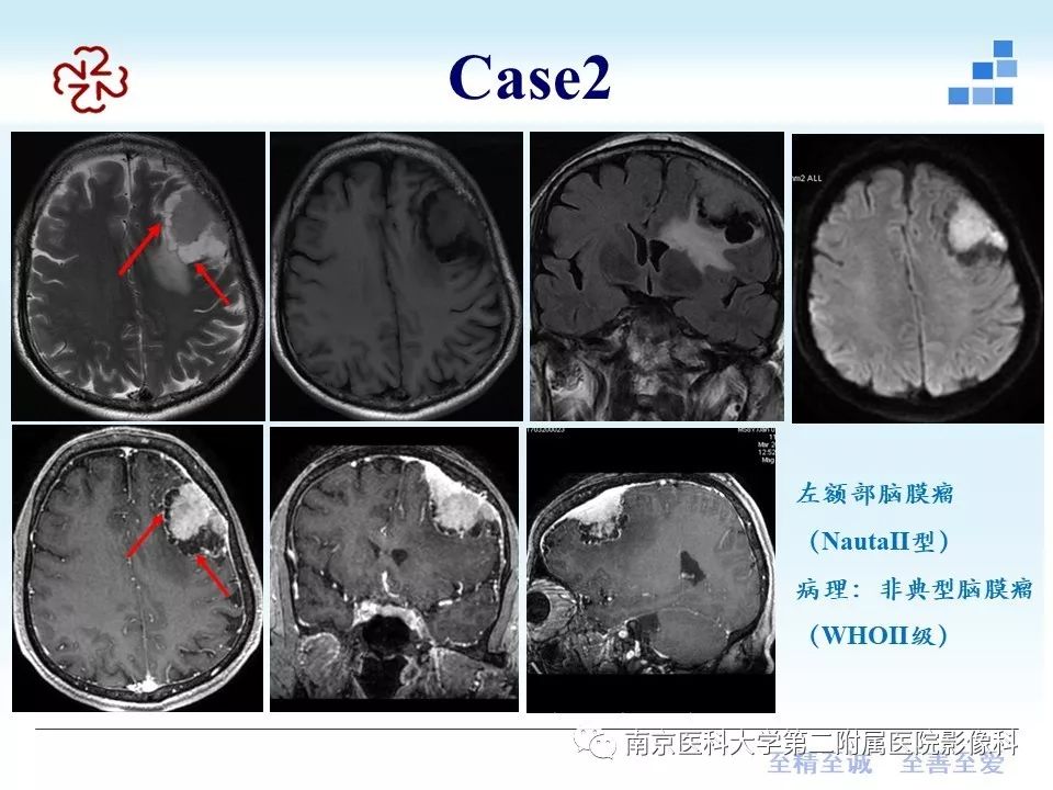 【PPT】囊性脑膜瘤