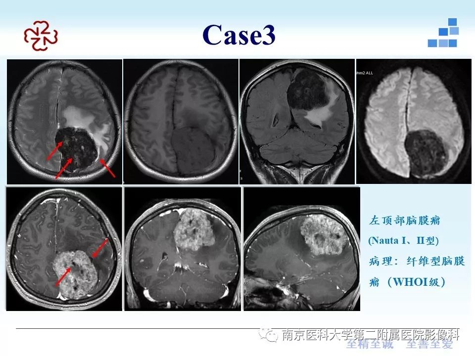 【PPT】囊性脑膜瘤