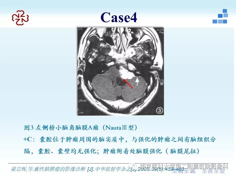 【PPT】囊性脑膜瘤