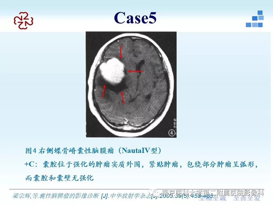 【PPT】囊性脑膜瘤