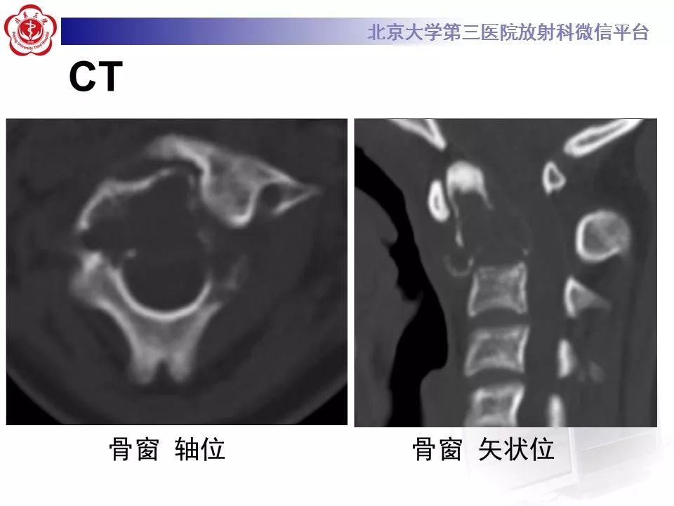 【病例】颈椎骨巨细胞瘤1例CT及MR影像诊断