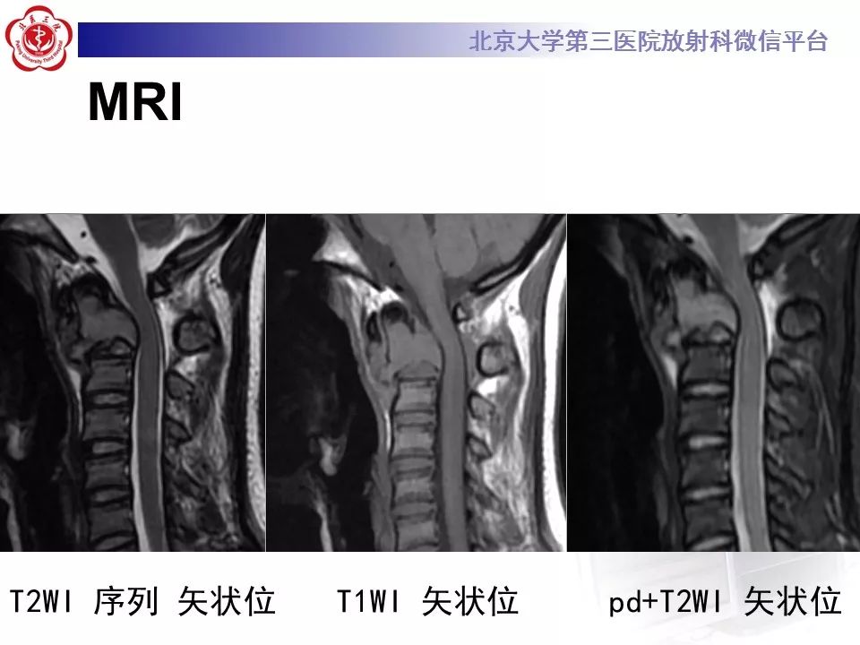 【病例】颈椎骨巨细胞瘤1例CT及MR影像诊断