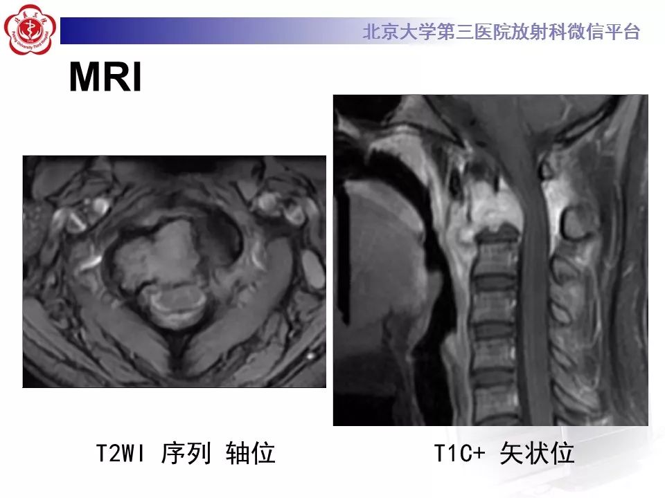 【病例】颈椎骨巨细胞瘤1例CT及MR影像诊断