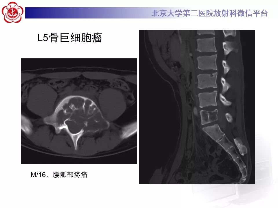 【病例】颈椎骨巨细胞瘤1例CT及MR影像诊断