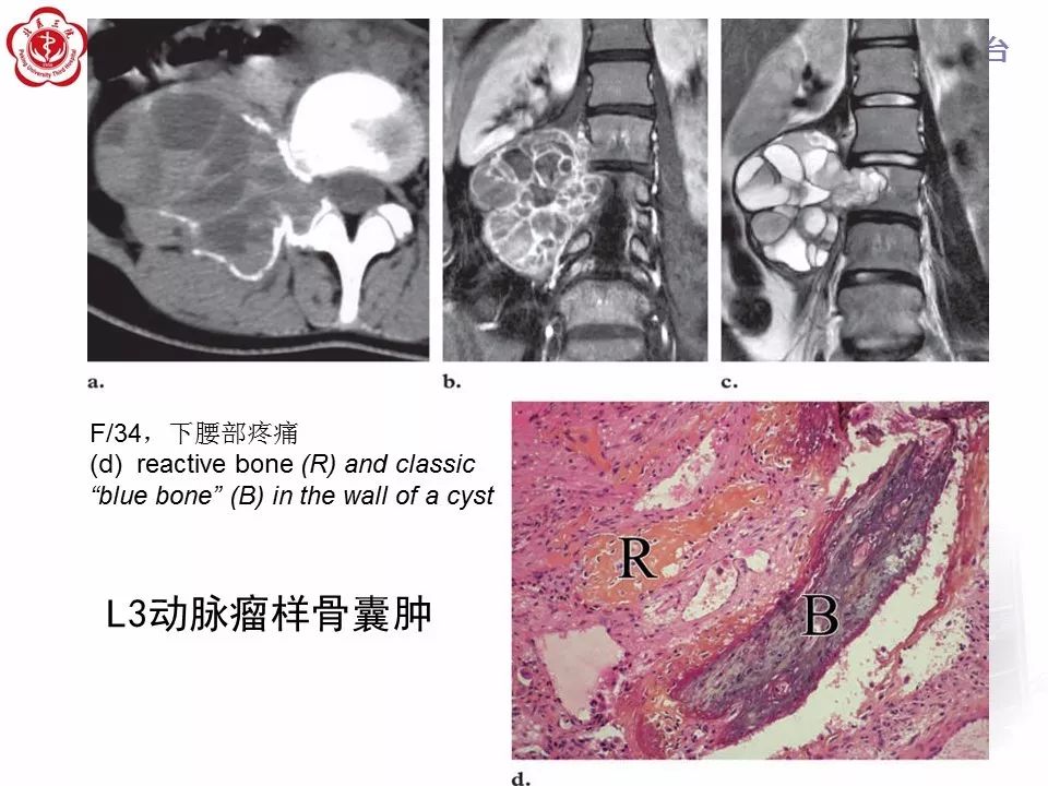 【病例】颈椎骨巨细胞瘤1例CT及MR影像诊断