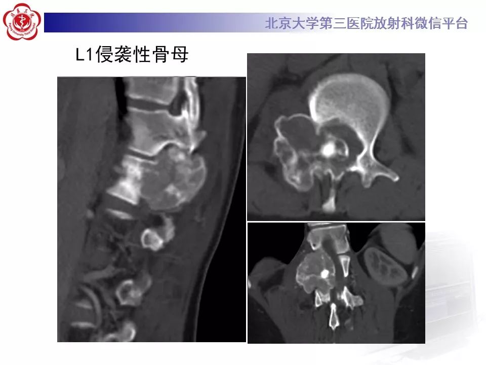 【病例】颈椎骨巨细胞瘤1例CT及MR影像诊断