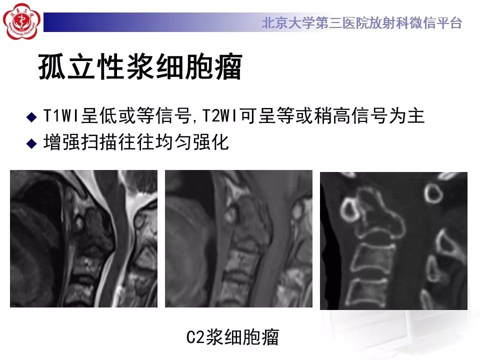 【病例】颈椎骨巨细胞瘤1例CT及MR影像诊断