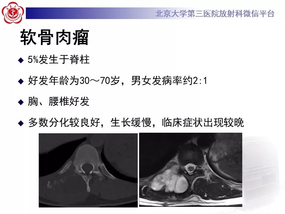 【病例】颈椎骨巨细胞瘤1例CT及MR影像诊断