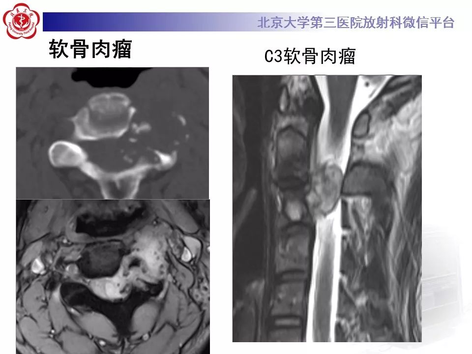 【病例】颈椎骨巨细胞瘤1例CT及MR影像诊断