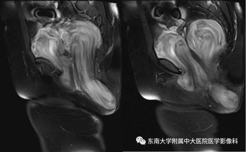 【病例】盆部侵袭性血管粘液瘤1例CT及MR影像诊断