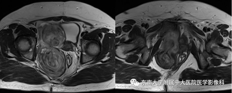 【病例】盆部侵袭性血管粘液瘤1例CT及MR影像诊断