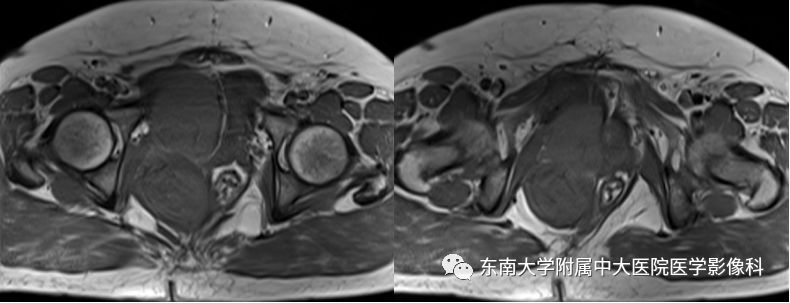 【病例】盆部侵袭性血管粘液瘤1例CT及MR影像诊断