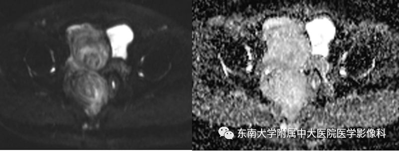 【病例】盆部侵袭性血管粘液瘤1例CT及MR影像诊断