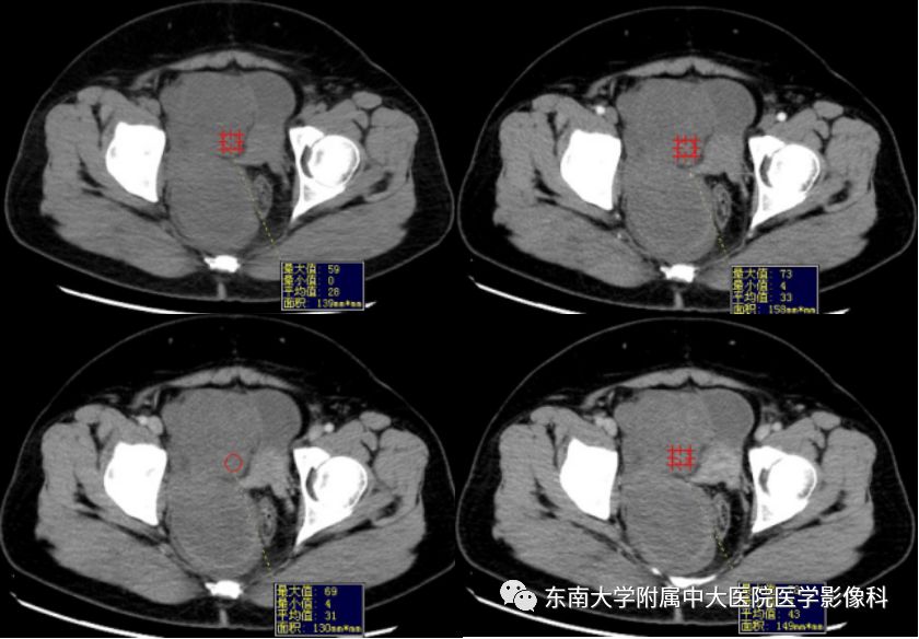 【病例】盆部侵袭性血管粘液瘤1例CT及MR影像诊断