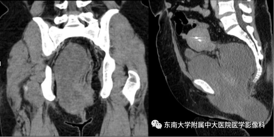 【病例】盆部侵袭性血管粘液瘤1例CT及MR影像诊断