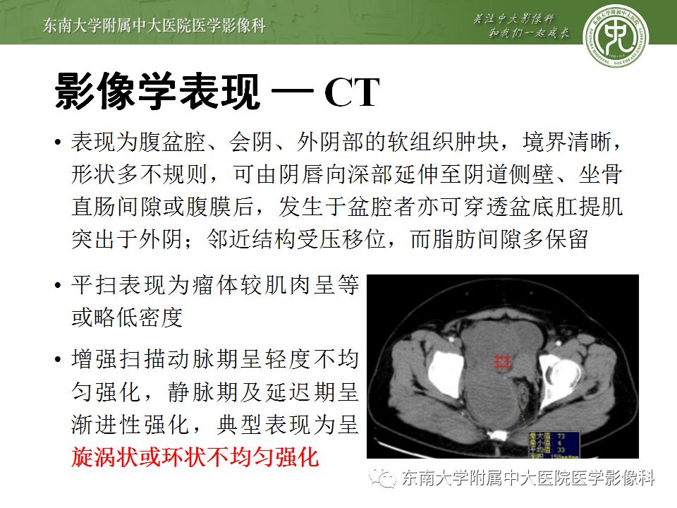 【病例】盆部侵袭性血管粘液瘤1例CT及MR影像诊断