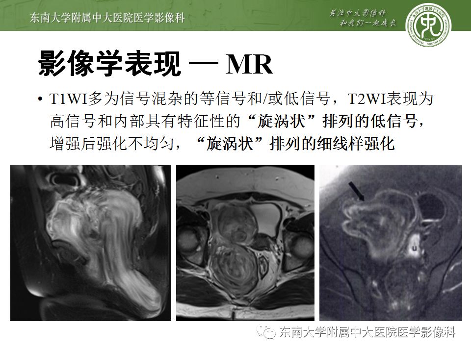 【病例】盆部侵袭性血管粘液瘤1例CT及MR影像诊断