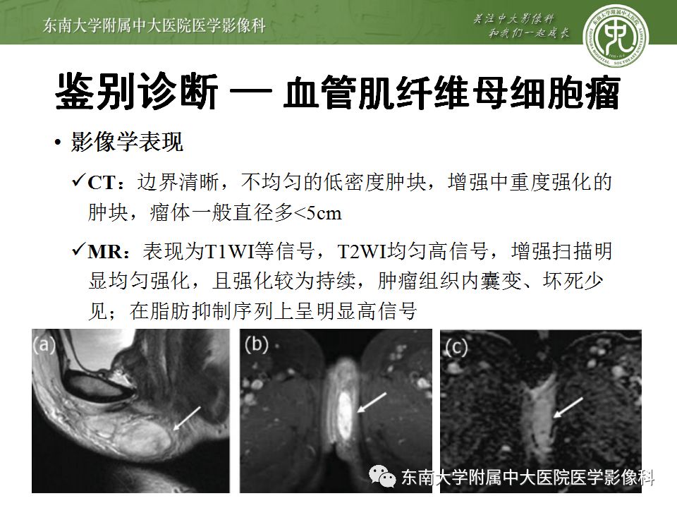 【病例】盆部侵袭性血管粘液瘤1例CT及MR影像诊断