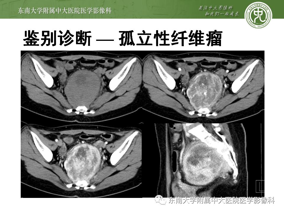 【病例】盆部侵袭性血管粘液瘤1例CT及MR影像诊断